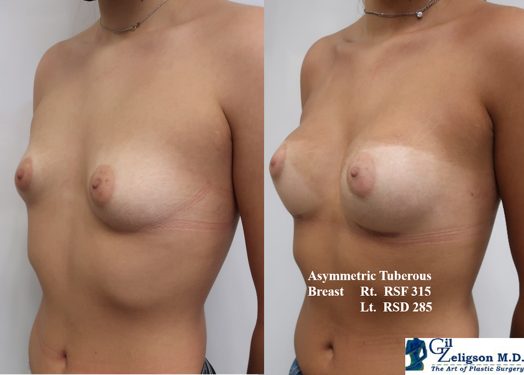 Dr. Gil Zeligson - Breast Asymmetry Correction