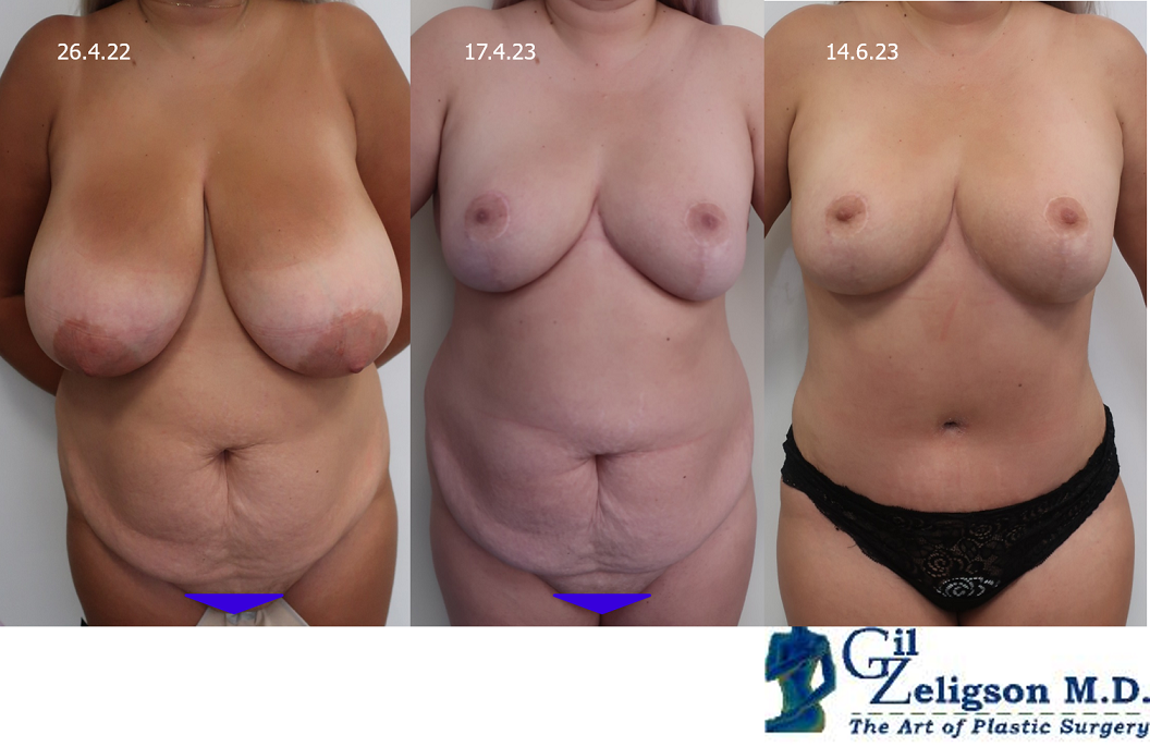 Dr. Gil Zeligson - Breast Reduction