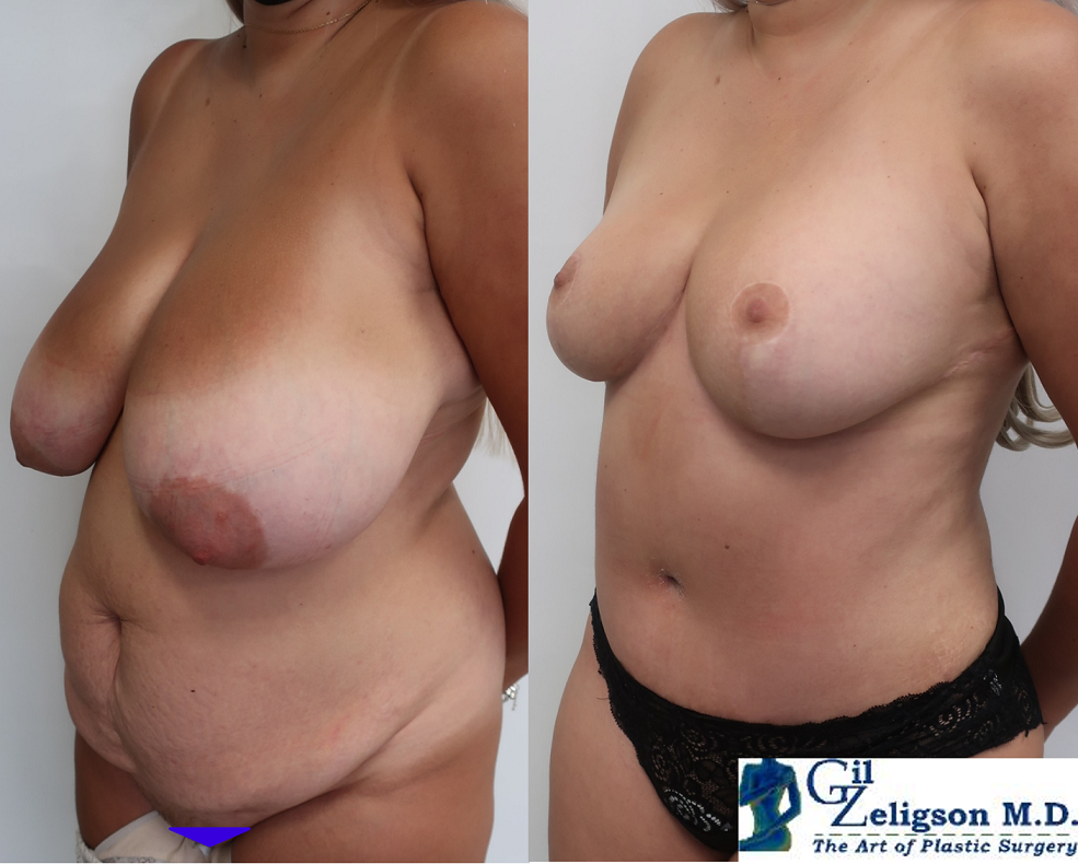 Dr. Gil Zeligson - Breast Reduction