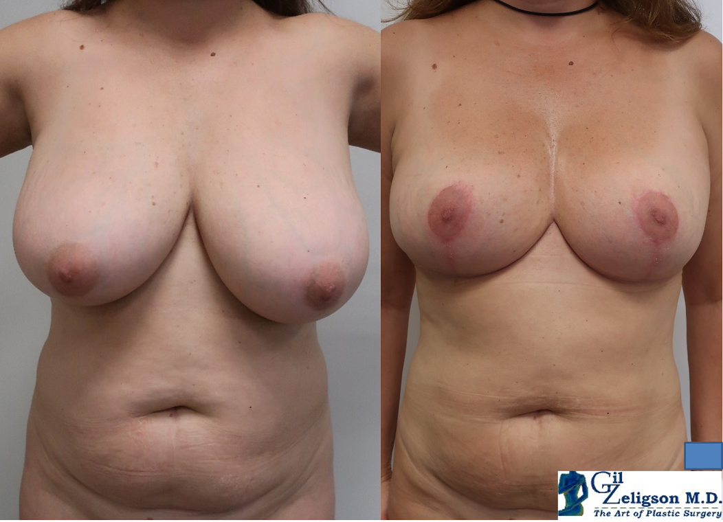 Dr. Gil Zeligson - Breast Reduction
