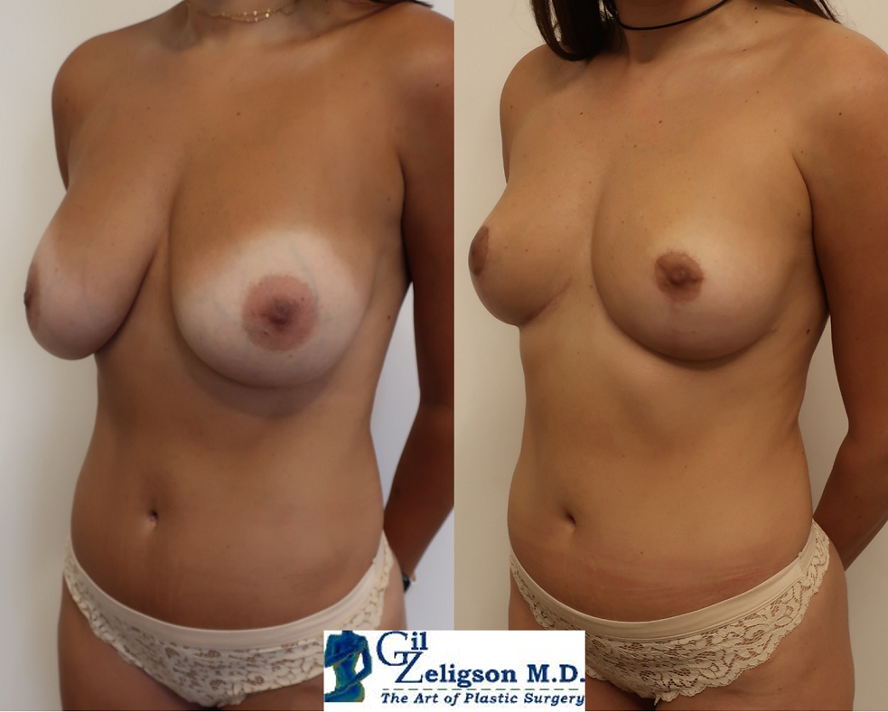 Dr. Gil Zeligson - Breast Reduction