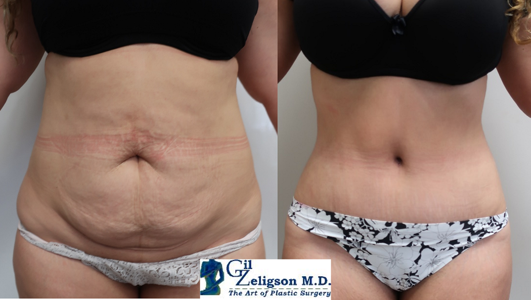 Dr. Gil Zeligson - Tummy Tuck Abdomino plasty