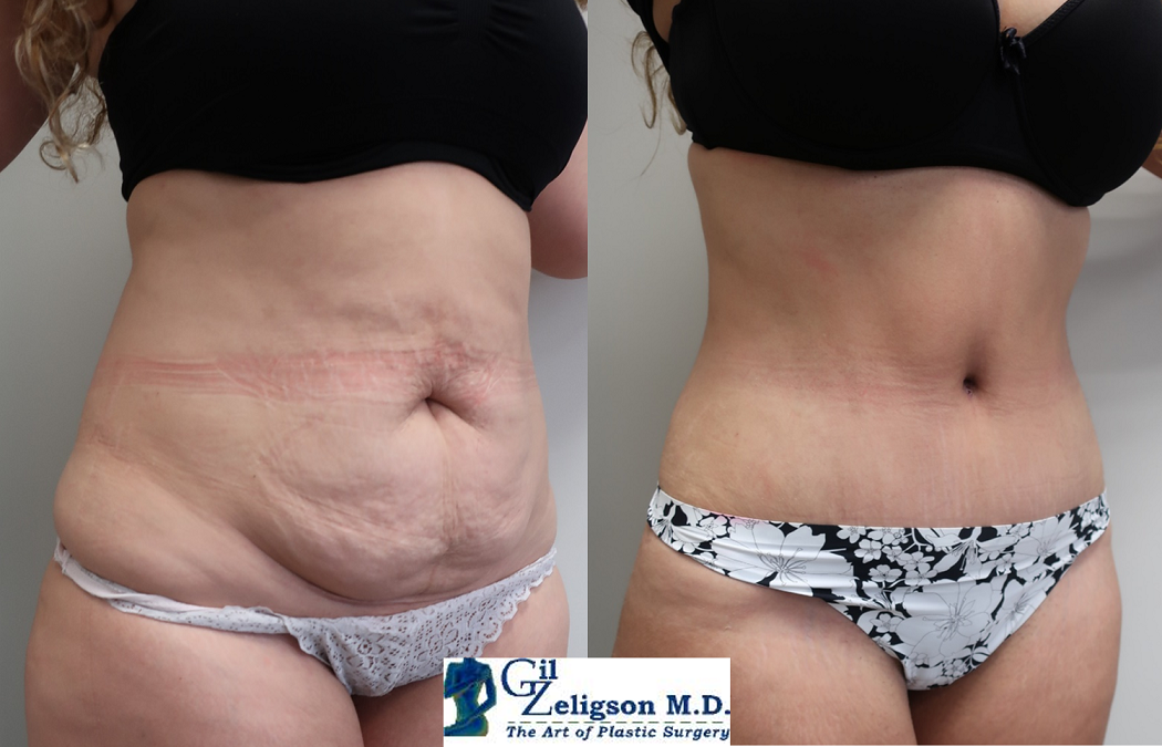 Dr. Gil Zeligson - Tummy Tuck Abdomino plasty