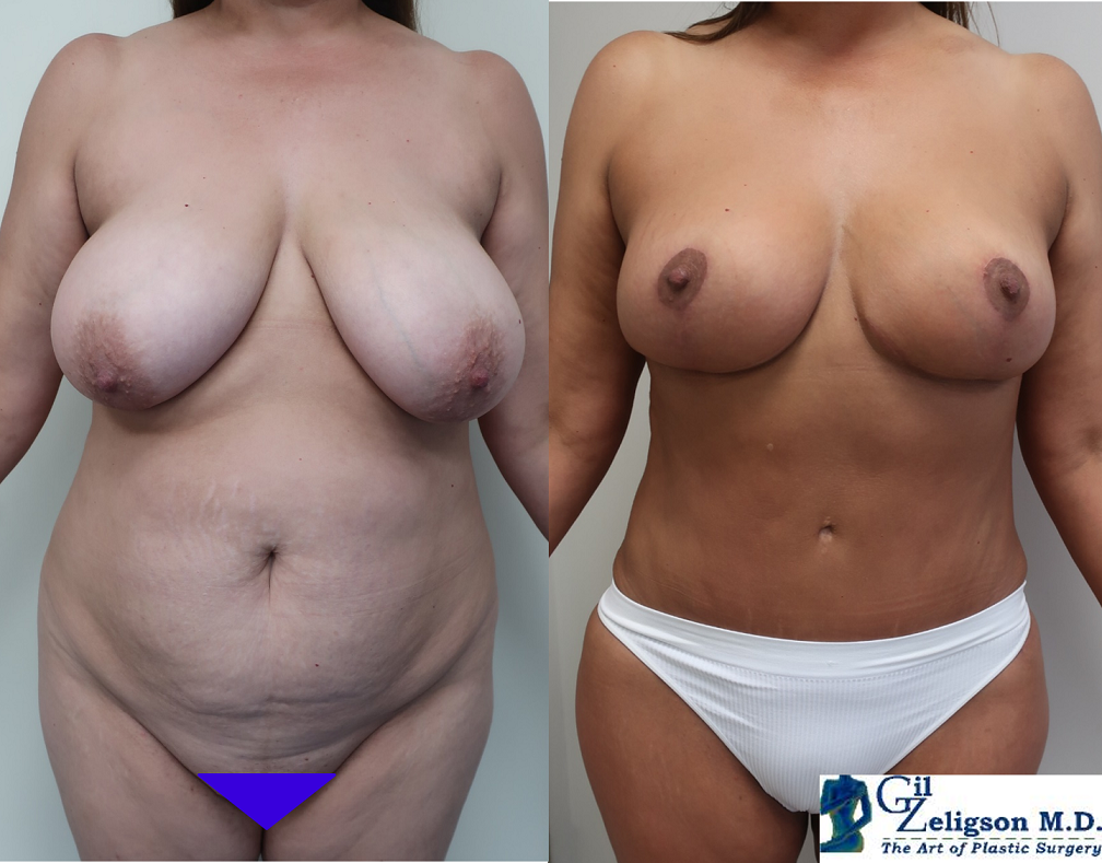 Dr. Gil Zeligson - Tummy Tuck Abdomino plasty