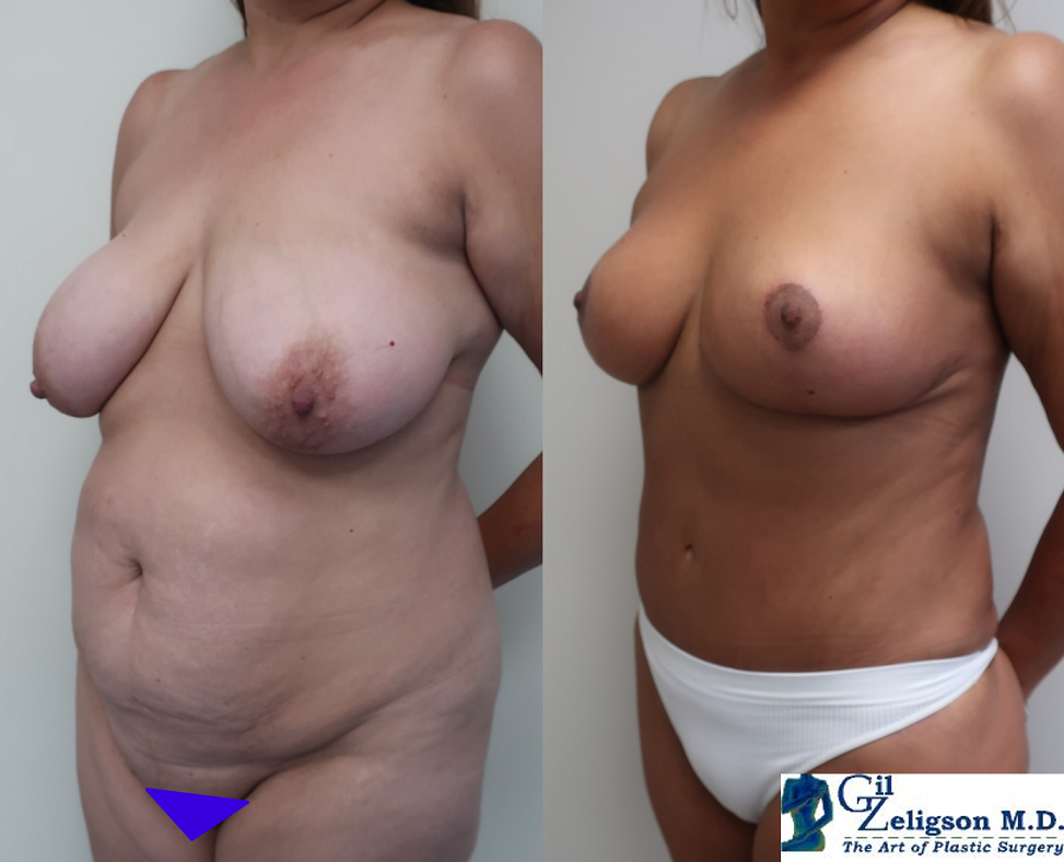 Dr. Gil Zeligson - Tummy Tuck Abdomino plasty