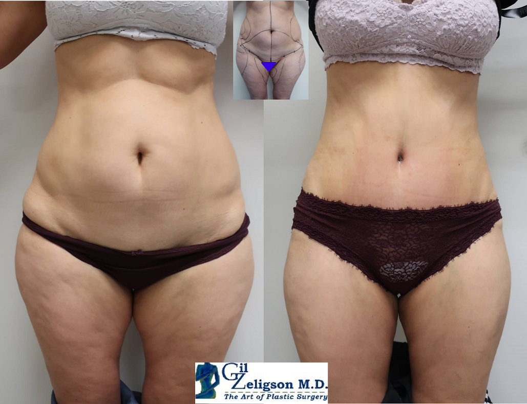 Dr. Gil Zeligson - Tummy Tuck Abdomino plasty