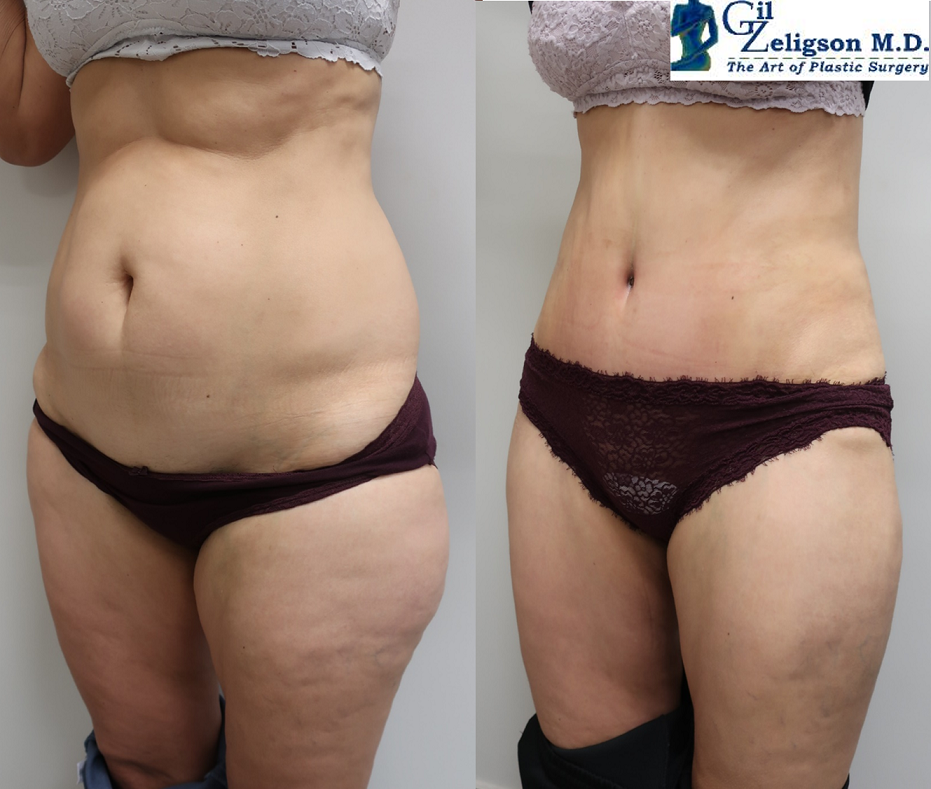 Dr. Gil Zeligson - Liposuction