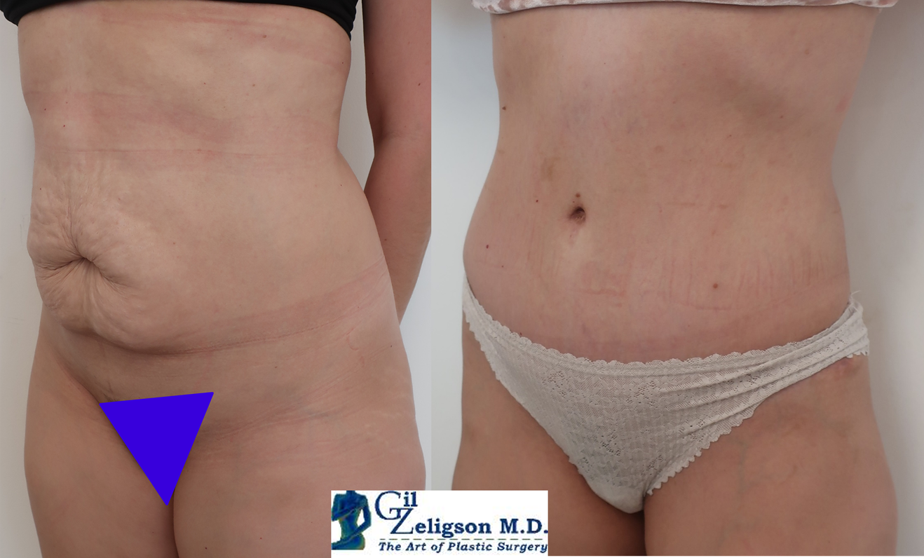 Dr. Gil Zeligson - Tummy Tuck Abdomino plasty