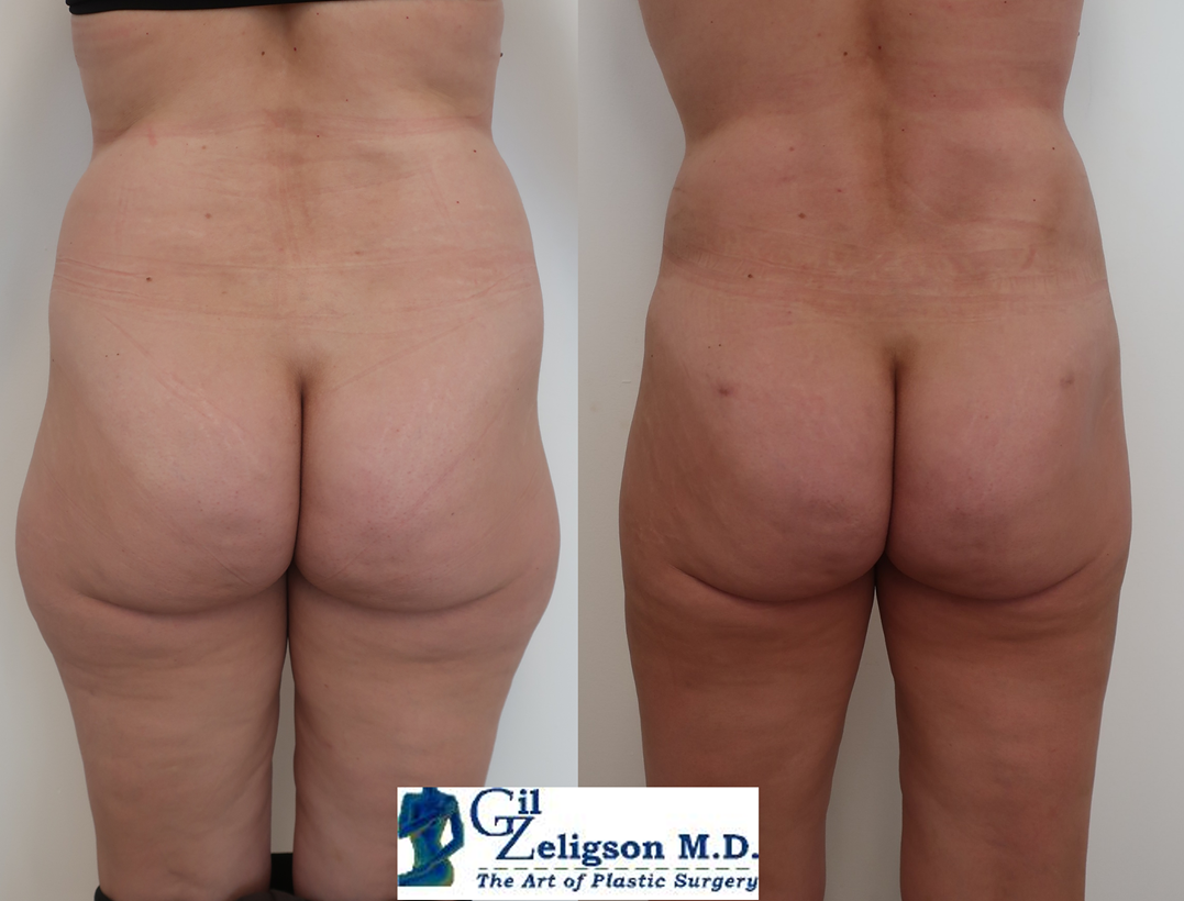 Dr. Gil Zeligson - Tummy Tuck Abdomino plasty