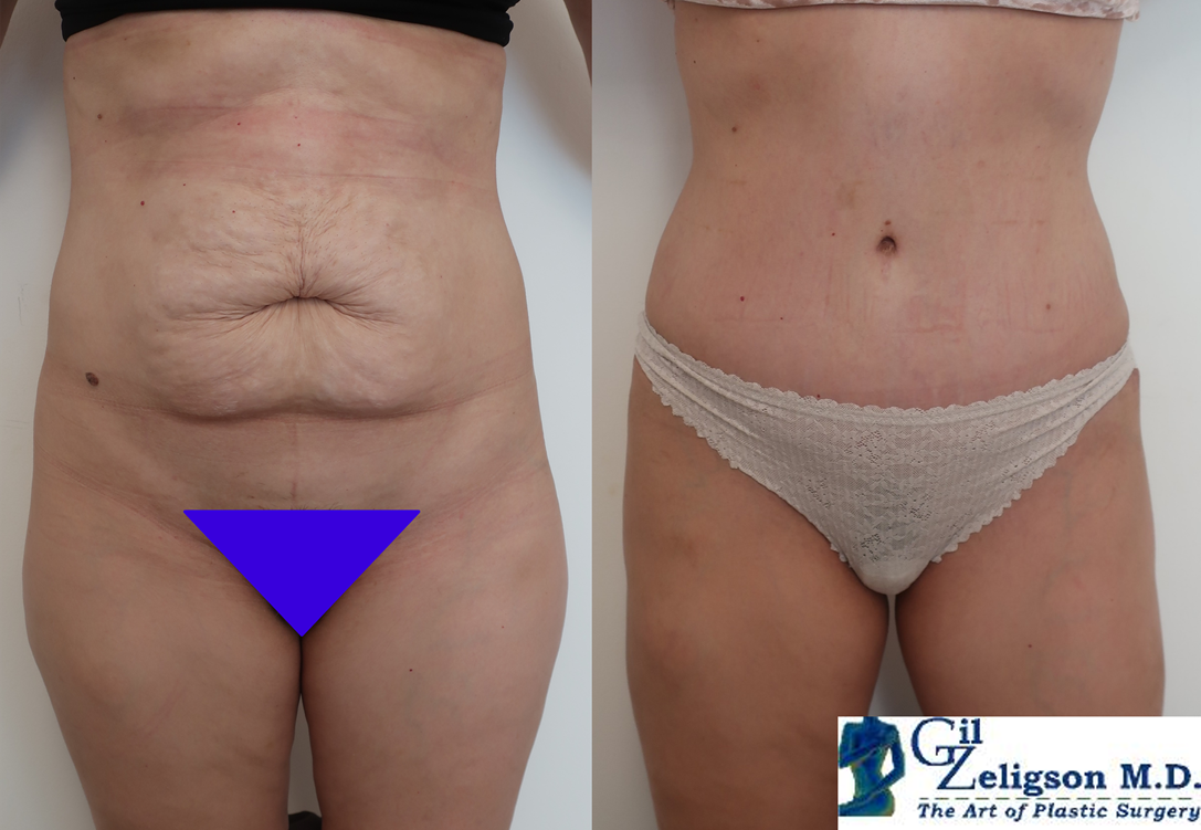 Dr. Gil Zeligson - Tummy Tuck Abdomino plasty