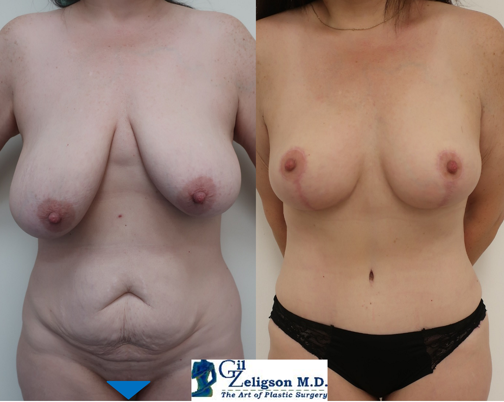 Dr. Gil Zeligson - Breast Asymmetry Correction