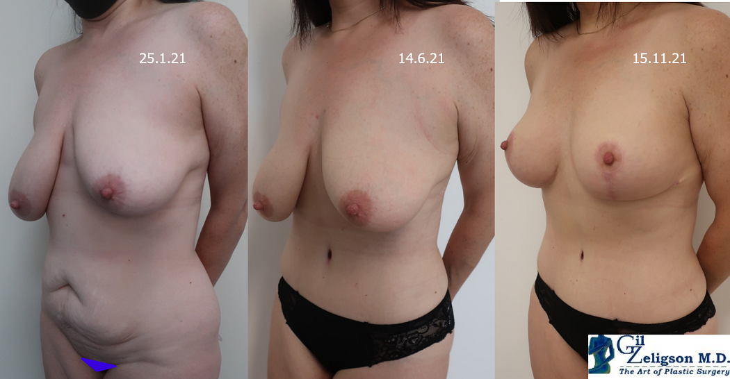 Dr. Gil Zeligson - Tummy Tuck Abdomino plasty