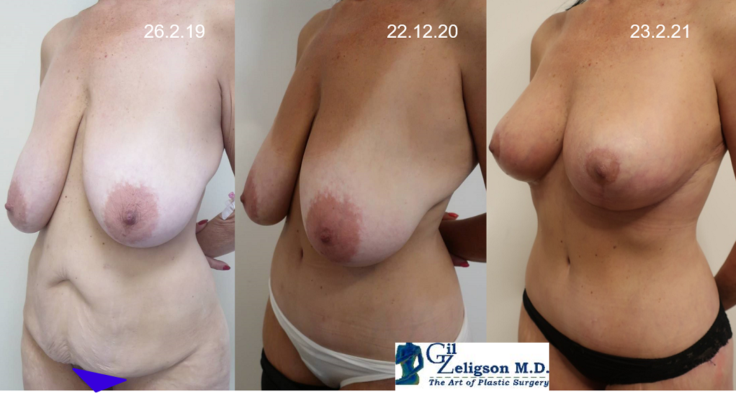 Dr. Gil Zeligson - Breast Reduction