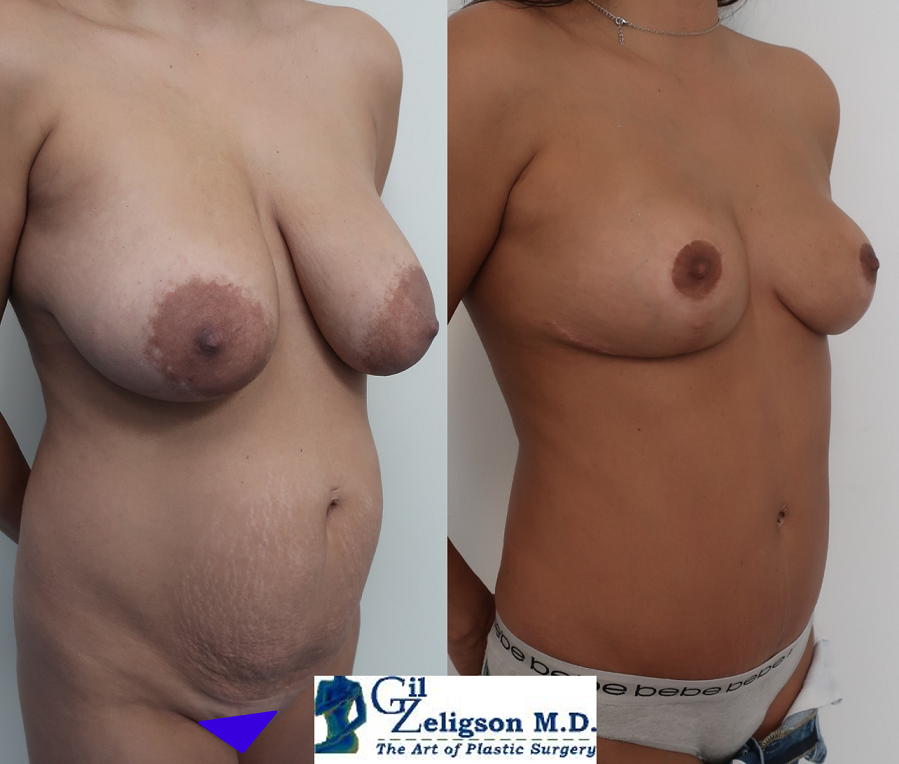 Dr. Gil Zeligson - Breast Reduction