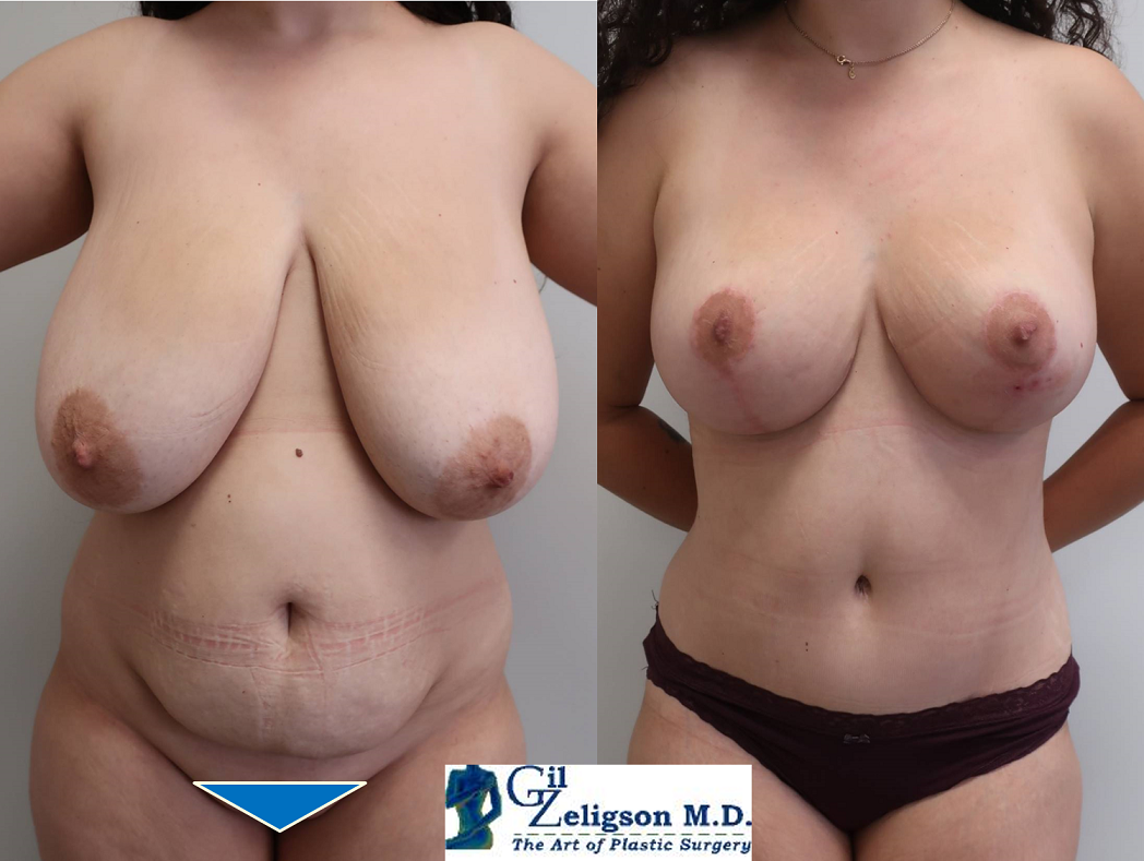 Dr. Gil Zeligson - Breast Reduction