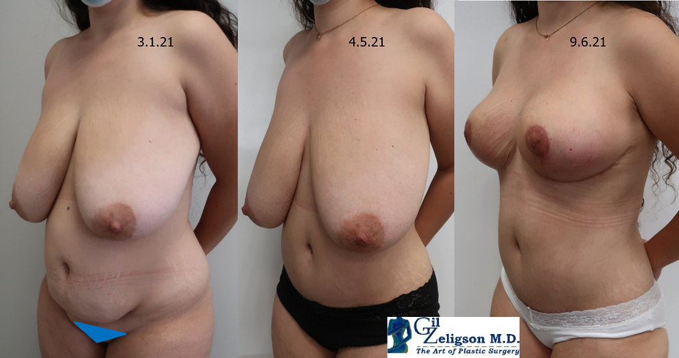 Dr. Gil Zeligson - Tummy Tuck Abdomino plasty