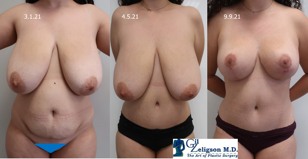 Dr. Gil Zeligson - Tummy Tuck Abdomino plasty