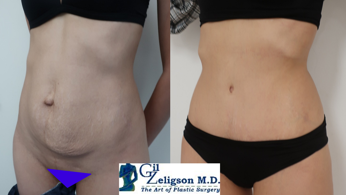 Dr. Gil Zeligson - Tummy Tuck Abdomino plasty