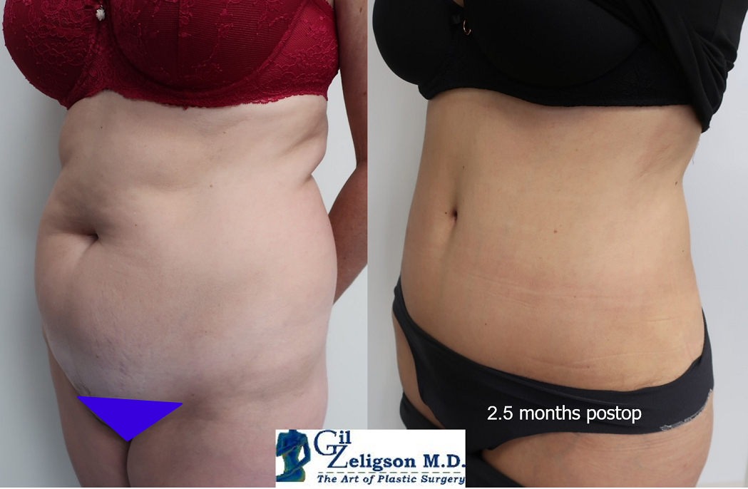 Dr. Gil Zeligson - Tummy Tuck Abdomino plasty