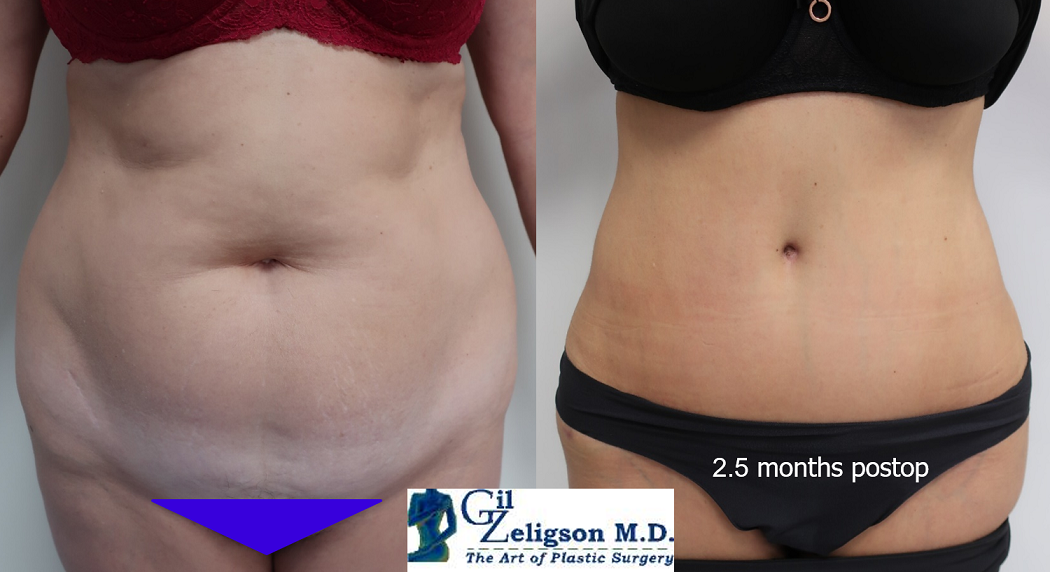 Dr. Gil Zeligson - Tummy Tuck Abdomino plasty