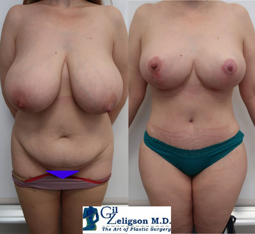 Dr. Gil Zeligson - Breast Reduction