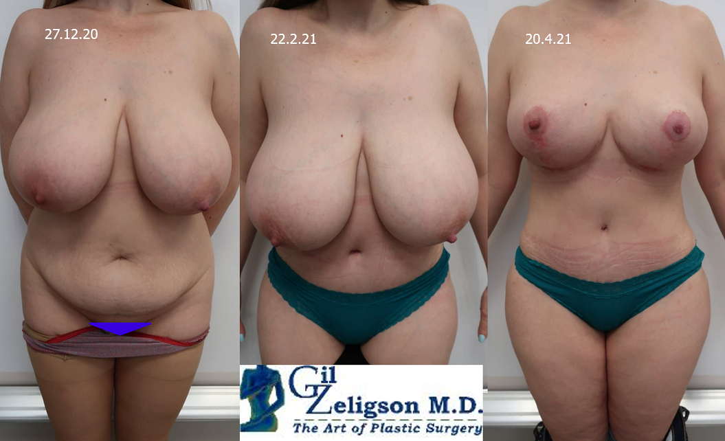 Dr. Gil Zeligson - Breast Reduction