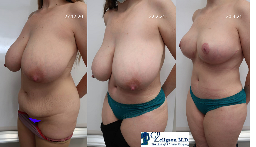 Dr. Gil Zeligson - Tummy Tuck Abdomino plasty