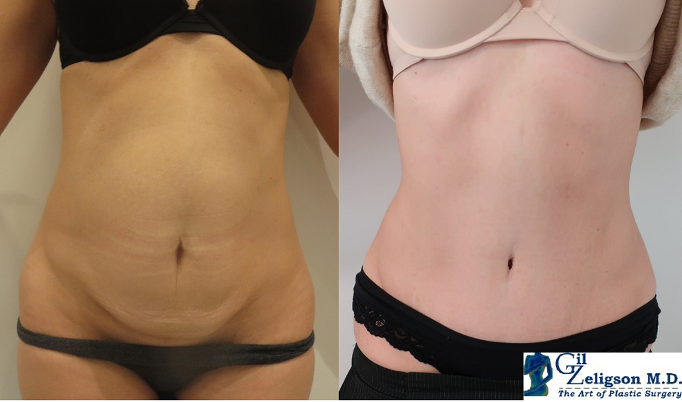 Dr. Gil Zeligson - Tummy Tuck Abdomino plasty