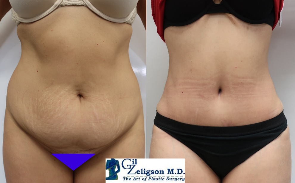 Dr. Gil Zeligson - Tummy Tuck Abdomino plasty