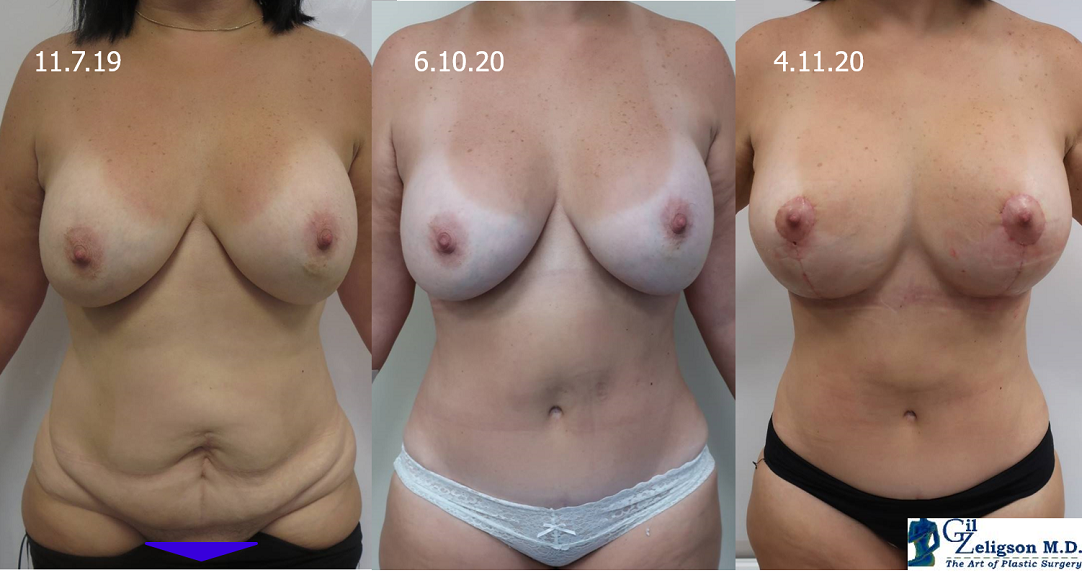 Dr. Gil Zeligson - Tummy Tuck Abdomino plasty