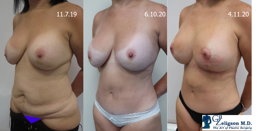 Dr. Gil Zeligson - Tummy Tuck Abdomino plasty