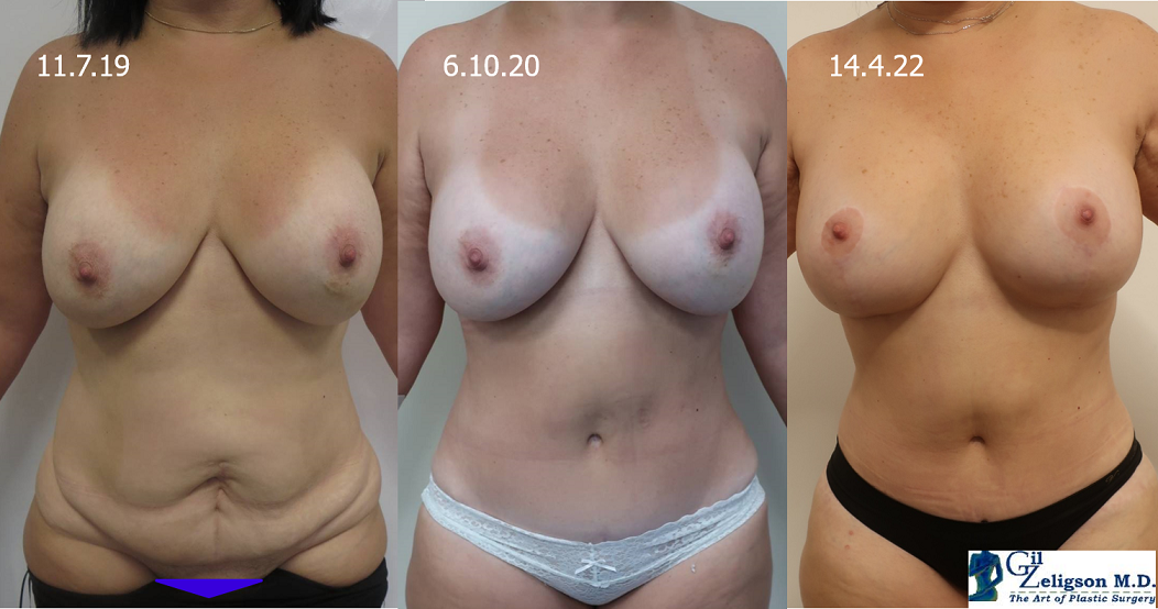 Dr. Gil Zeligson - Breast Reduction