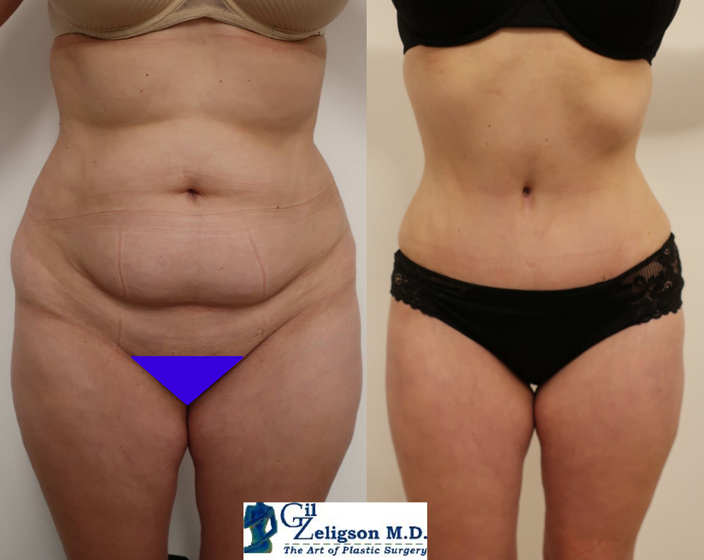 Dr. Gil Zeligson - Tummy Tuck Abdomino plasty