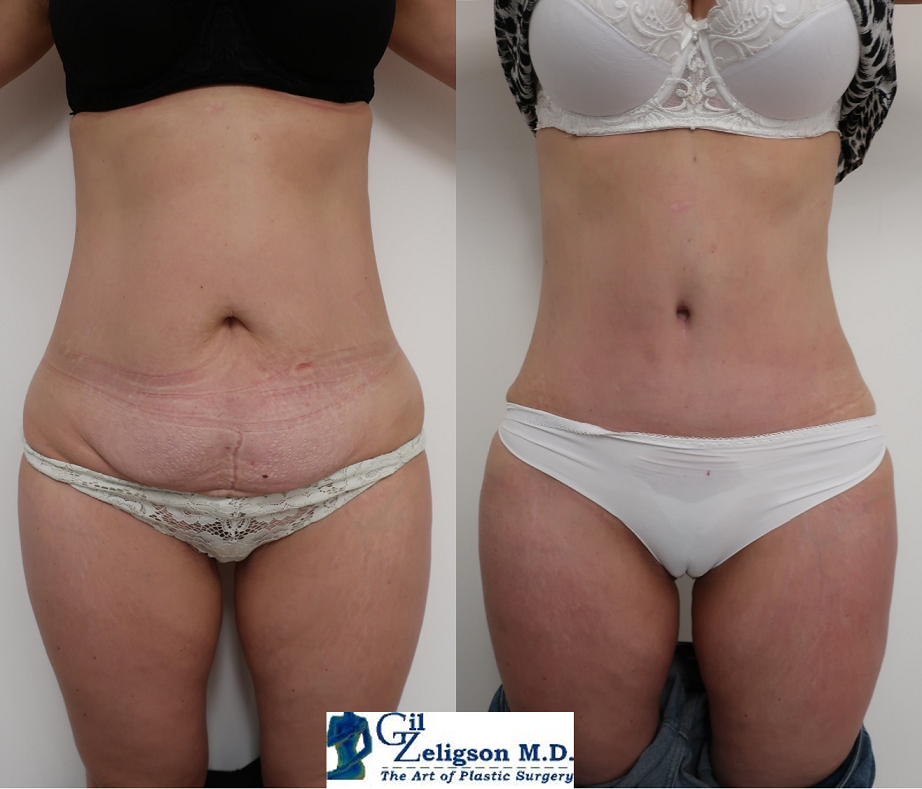 Dr. Gil Zeligson - Tummy Tuck Abdomino plasty