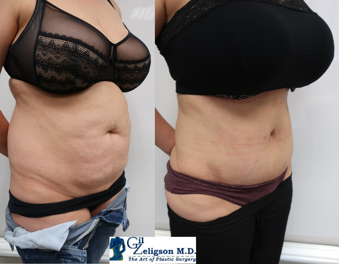 Dr. Gil Zeligson - Tummy Tuck Abdomino plasty