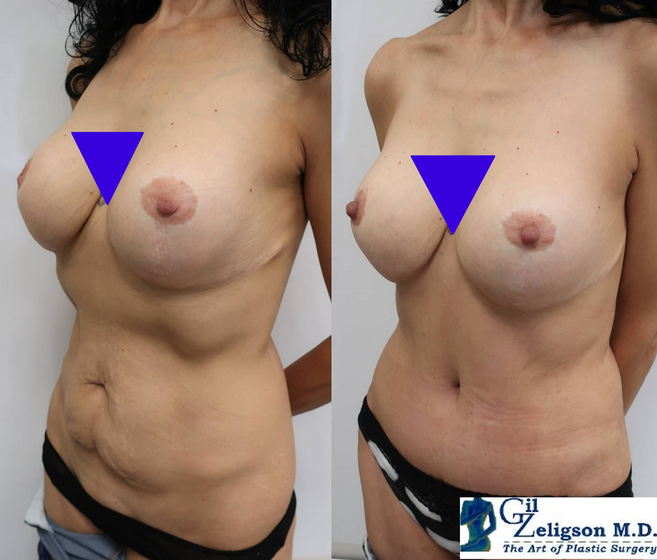 Dr. Gil Zeligson - Tummy Tuck Abdomino plasty