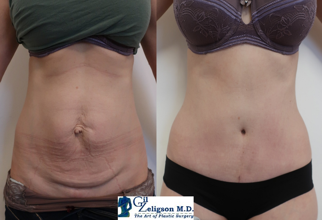 Dr. Gil Zeligson - Tummy Tuck Abdomino plasty