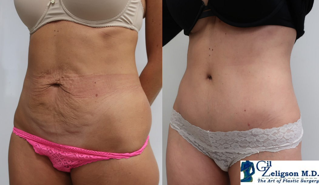 Dr. Gil Zeligson - Tummy Tuck Abdomino plasty