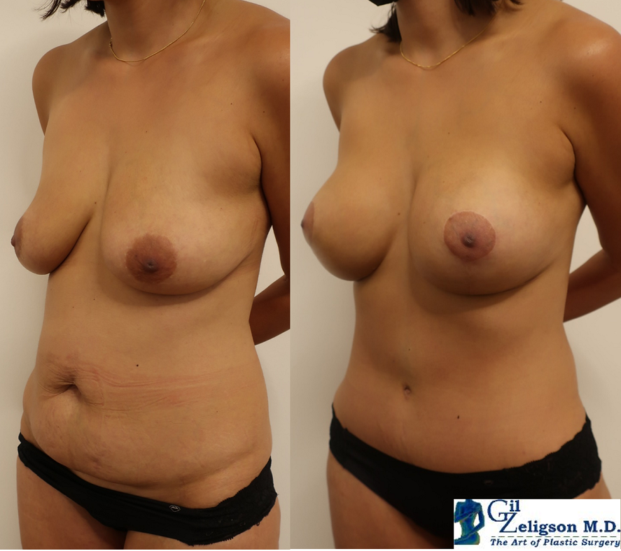 Dr. Gil Zeligson - Tummy Tuck Abdomino plasty