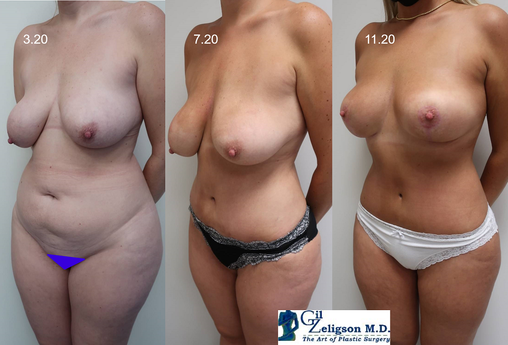 Dr. Gil Zeligson - Breast Reduction