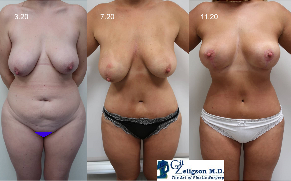 Dr. Gil Zeligson - Breast Reduction