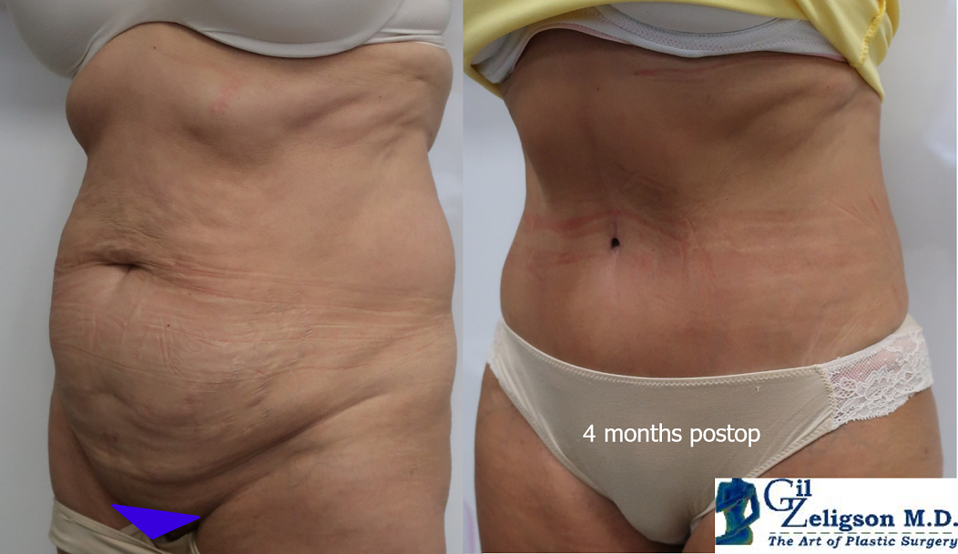 Dr. Gil Zeligson - Tummy Tuck Abdomino plasty