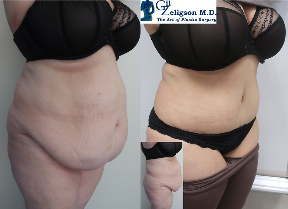 Dr. Gil Zeligson - Tummy Tuck Abdomino plasty
