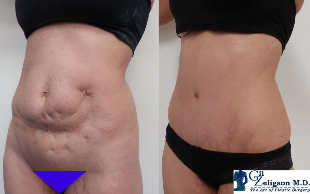 Dr. Gil Zeligson - Tummy Tuck Abdomino plasty