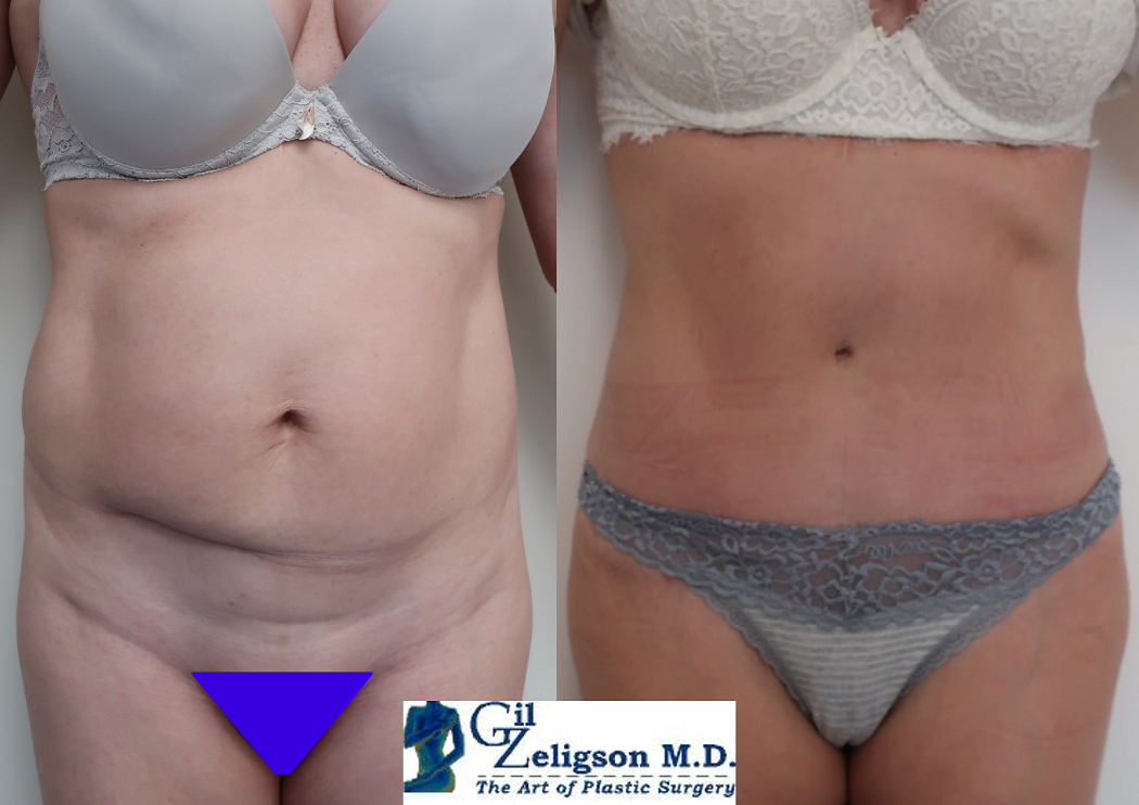 Dr. Gil Zeligson - Tummy Tuck Abdomino plasty
