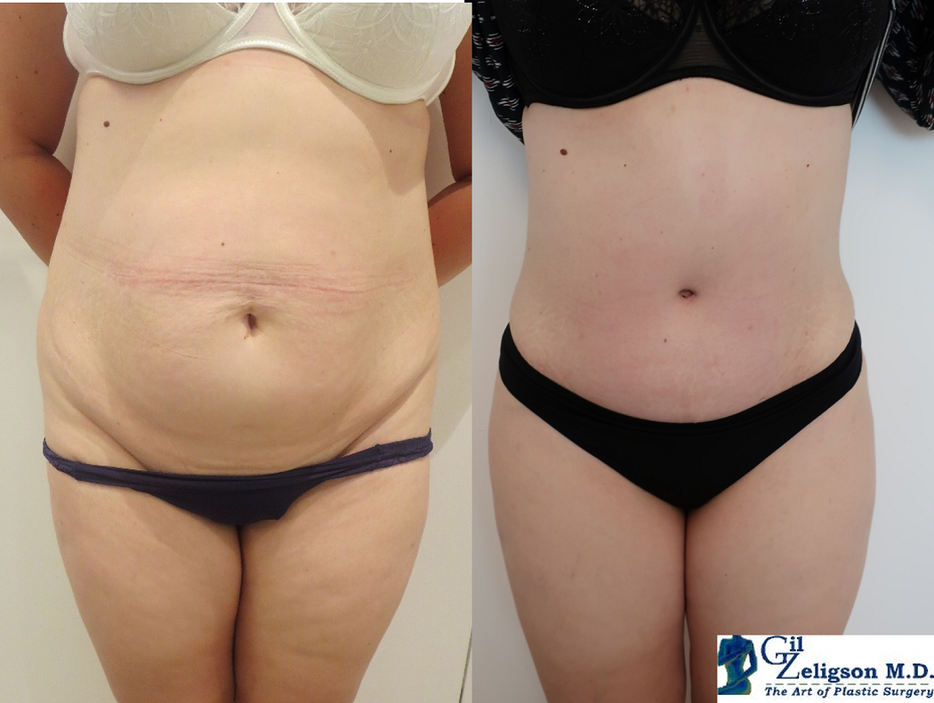 Dr. Gil Zeligson - Tummy Tuck Abdomino plasty