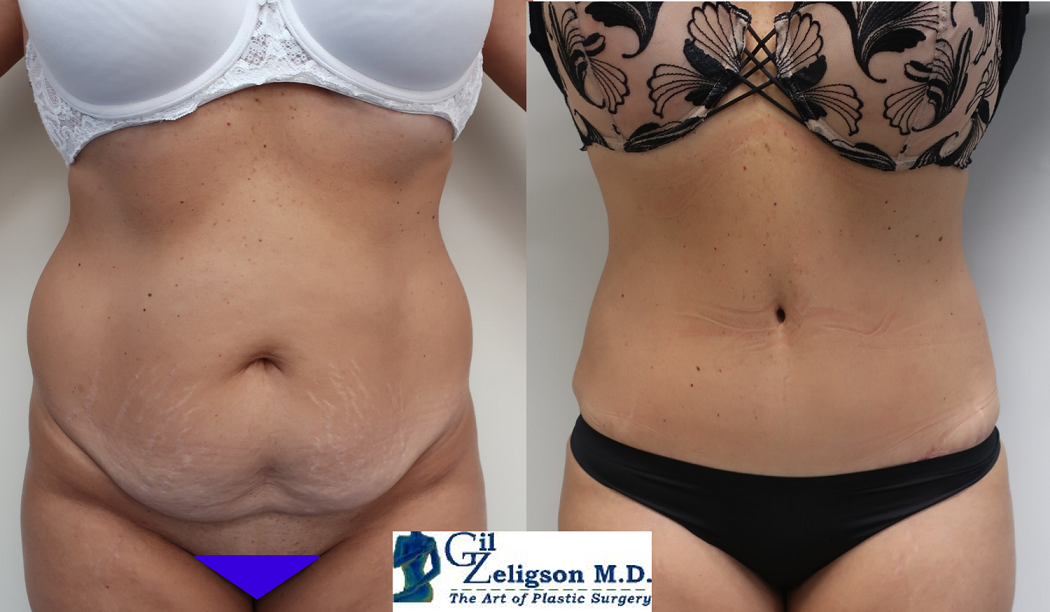 Dr. Gil Zeligson - Tummy Tuck Abdomino plasty