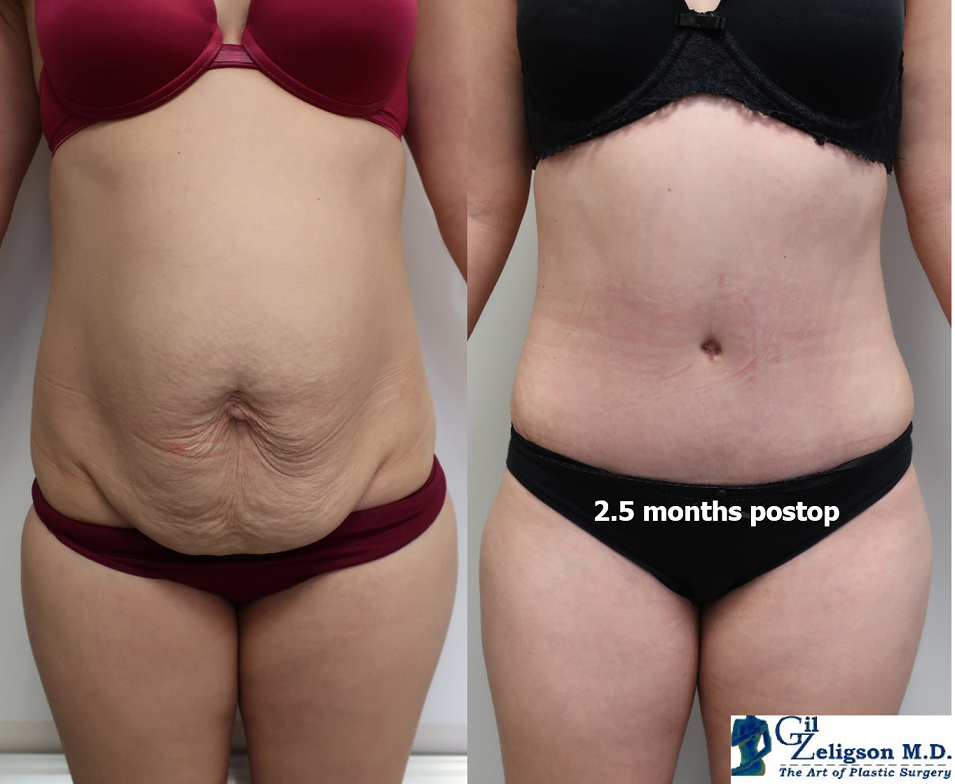 Dr. Gil Zeligson - Liposuction