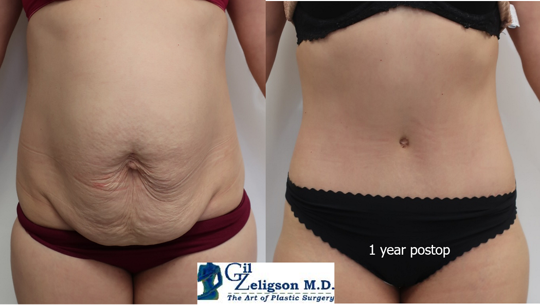 Dr. Gil Zeligson - Tummy Tuck Abdomino plasty