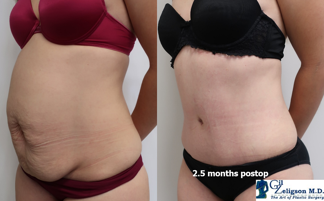 Dr. Gil Zeligson - Liposuction